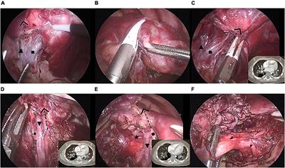 Modified thoracoscopic wedge resection of limited peripheral lesions in S10 for children with congenital pulmonary airway malformation: Initial single-center experience